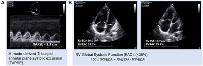 Non-invasive imaging techniques for early diagnosis of bilateral cardiac dysfunction in pulmonary hypertension: current crests, future peaks